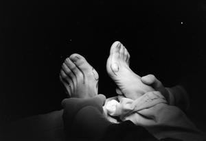 [Bunion surgical site marking on feet]
