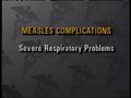 Video: [News Clip: Measles]